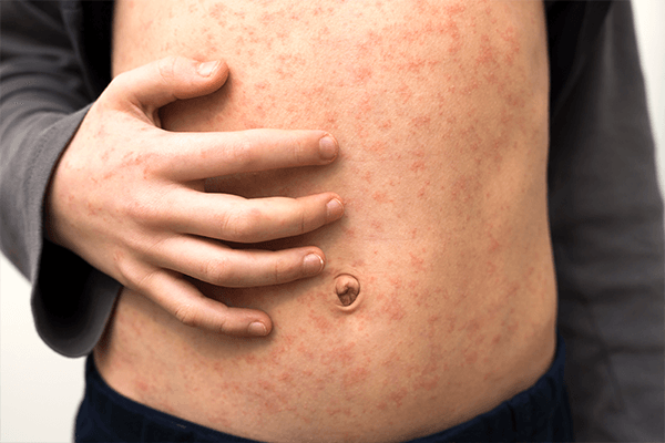 Epidemija majmunskih boginja u Evropi – karakteristike, razvoj, prognoza
